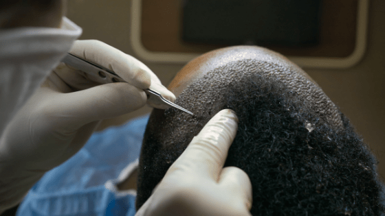 best hairtransplant centers in istanbul (1)