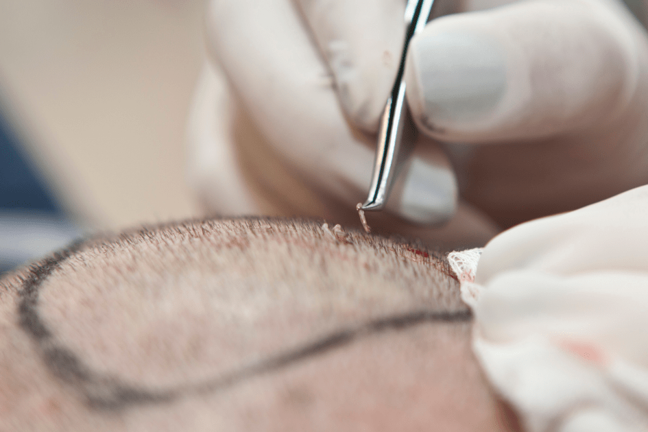 best hair transplant centers in istanbul
